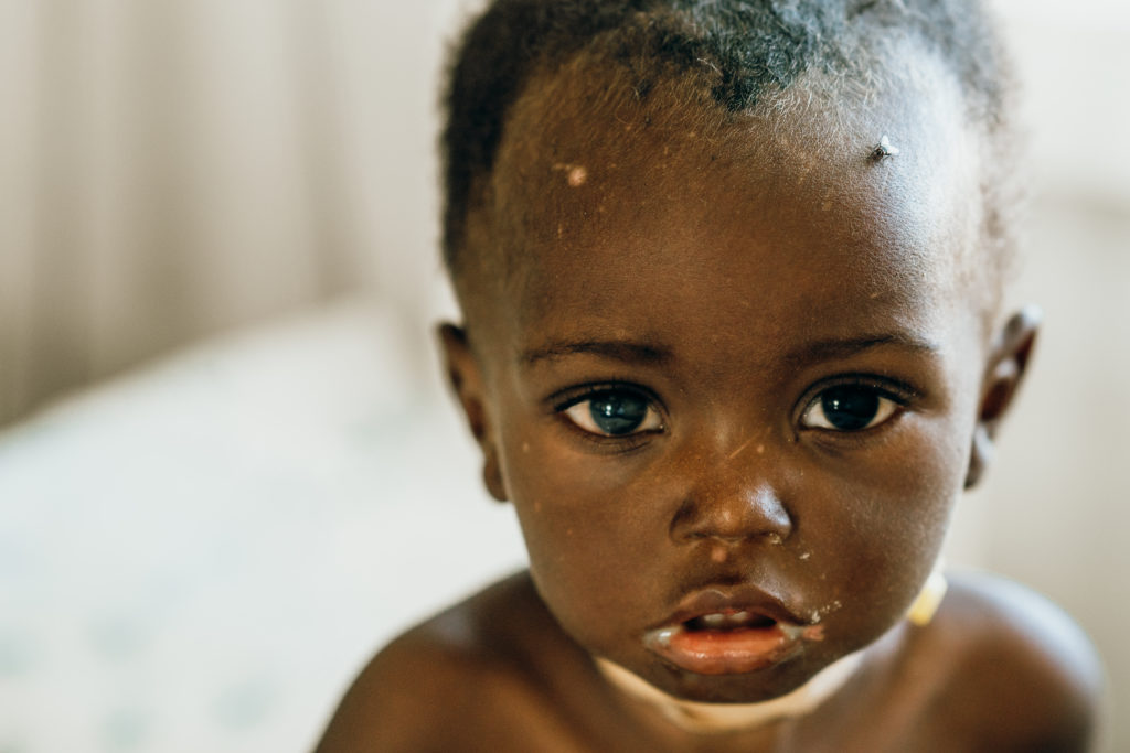 A malnourished baby in Angola.