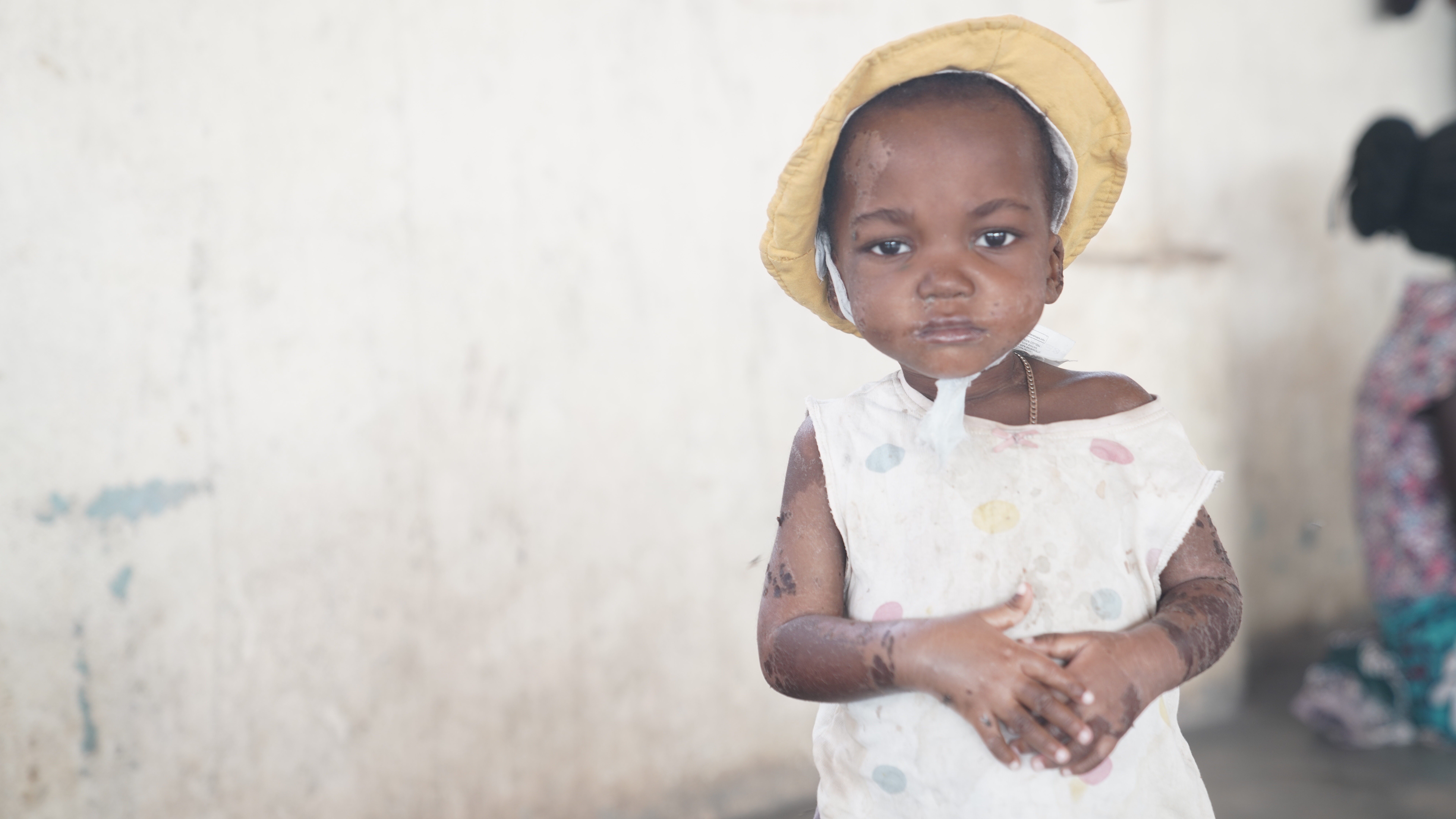 Child in a polka dot dress and yellow hat, standing in a vulnerable environment, symbolizing the impact of donations for babies in need.