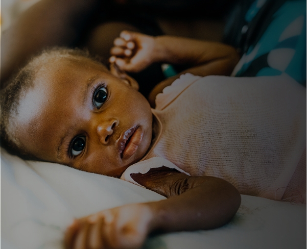 Infant with large, expressive eyes lying on a bed, highlighting the need for donations to support malnourished children in Sub-Saharan Africa.