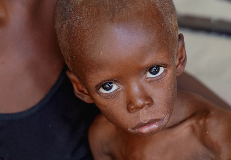 Child suffering from malnutrition, with prominent eyes and a fragile appearance, highlighting the urgent need for nutritional aid in remote areas.